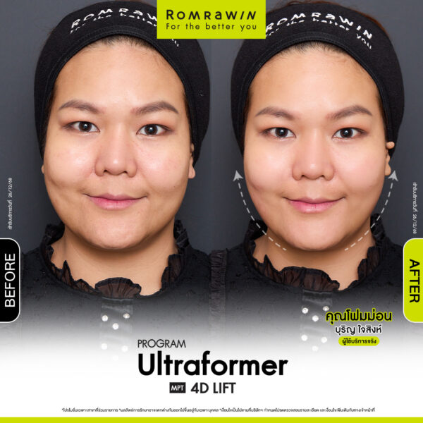 All Review 284 รีวิว Ultraformer MPT 4D Lift คุณโฟมม่อน