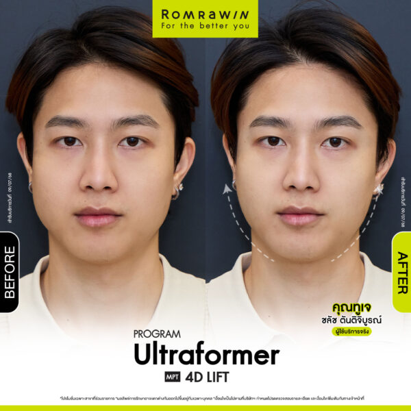 All Review 283 รีวิว Ultraformer MPT 4D Lift คุณทูเจ