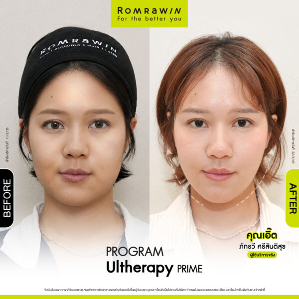 All Review 67 รีวิว Ultrerapy Prime คุณเอิ๊ต