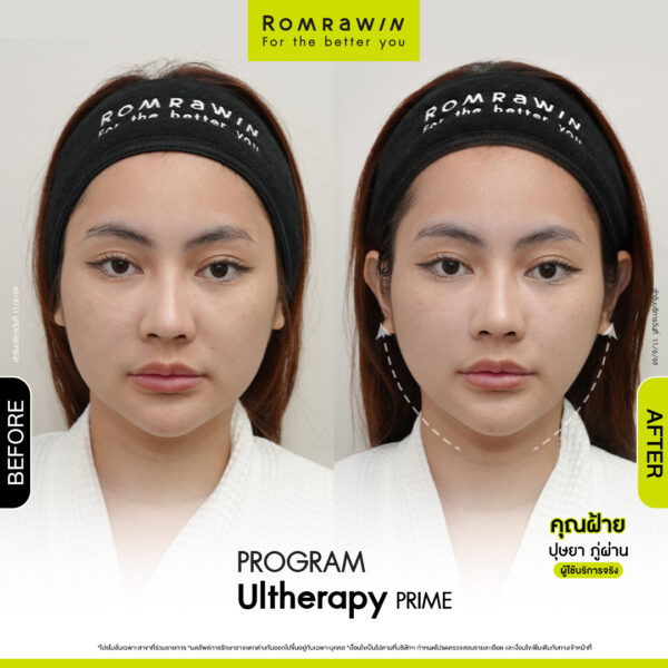 All Review 66 รีวิว Ultrerapy Prime คุณฝ้าย