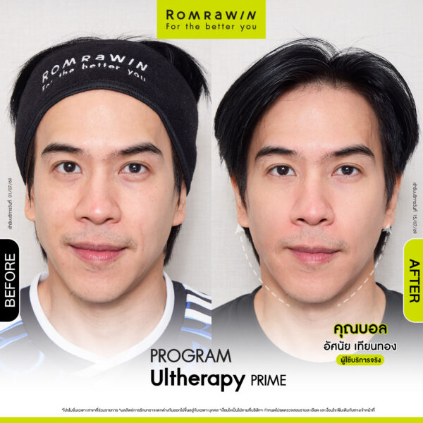 All Review 65 รีวิว Ultrerapy Prime คุณบอล