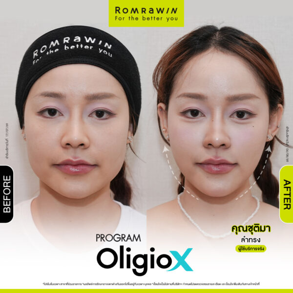All Review 26 รีวิว OligioX คุณชุติมา