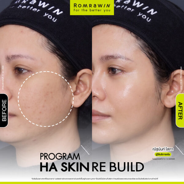All Review 262 รีวิว HA Skin Rebuild คุณณัฐนันท์