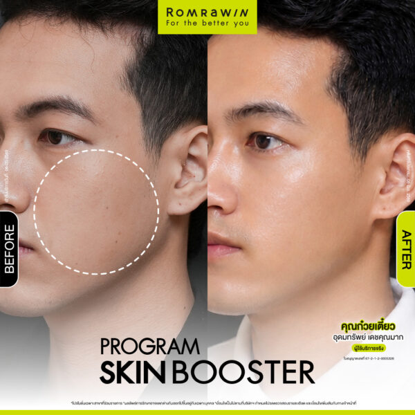 All Review 260 รีวิว Skinbooster คุณก๋วยเตี๋ยว