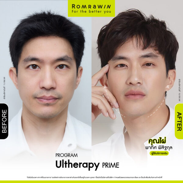 All Review 64 รีวิว Ultrerapy Prime คุณไผ่