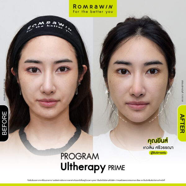 All Review 63 รีวิว Ultrerapy Prime คุณยีนส์