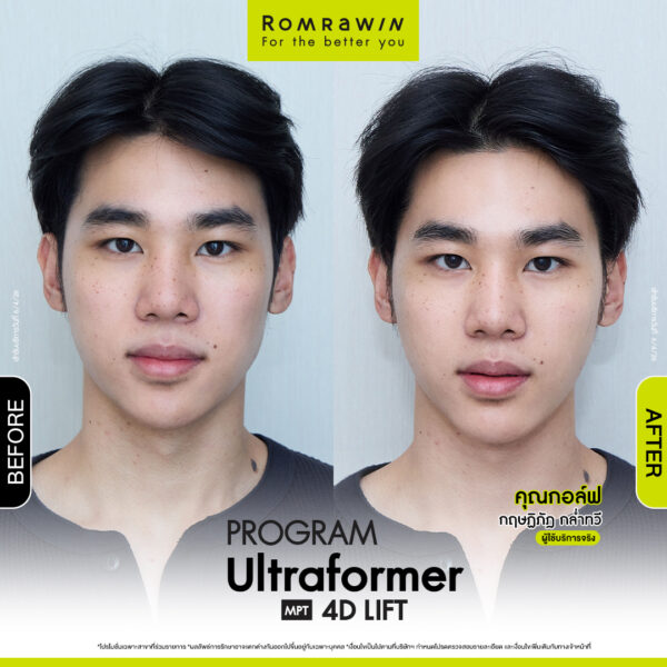All Review 280 รีวิว Ultraformer MPT 4D Lift คุณกอล์ฟ