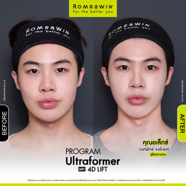 All Review 282 รีวิว Ultraformer MPT 4D Lift คุณอเล็กซ์
