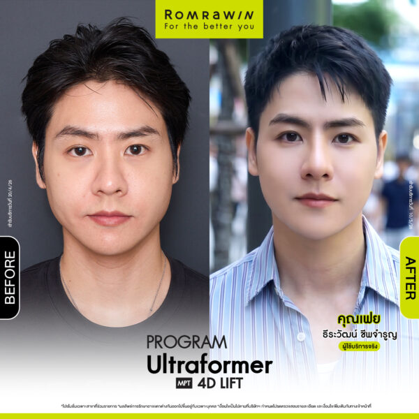 All Review 281 รีวิว Ultraformer MPT 4D Lift คุณเฟย