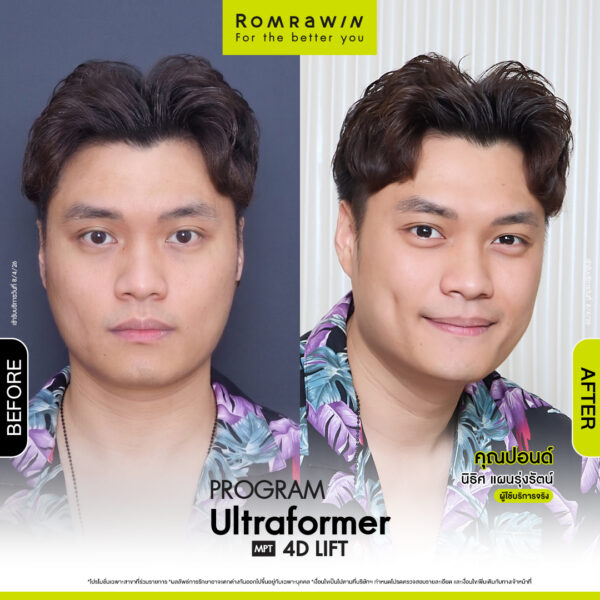 All Review 279 รีวิว Ultraformer MPT 4D Lift คุณปอนด์
