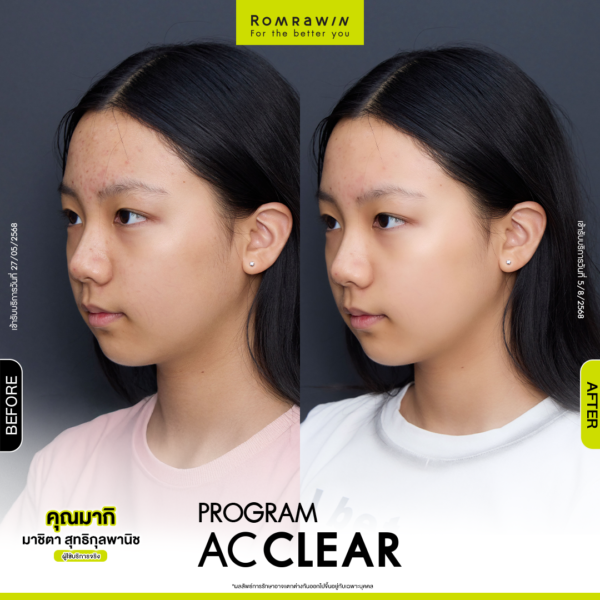 All Review 238 รีวิว Ac Clear คุณมากิ