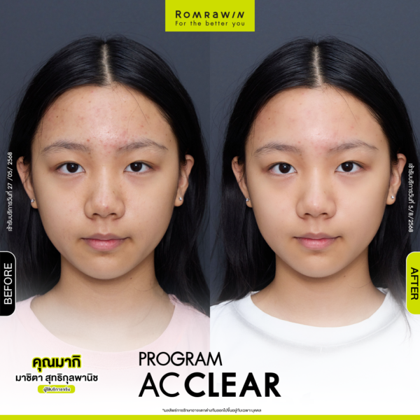 All Review 237 รีวิว Ac Clear คุณมากิ