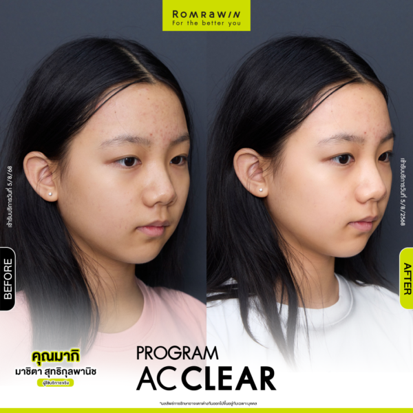 All Review 236 รีวิว Ac Clear คุณมากิ