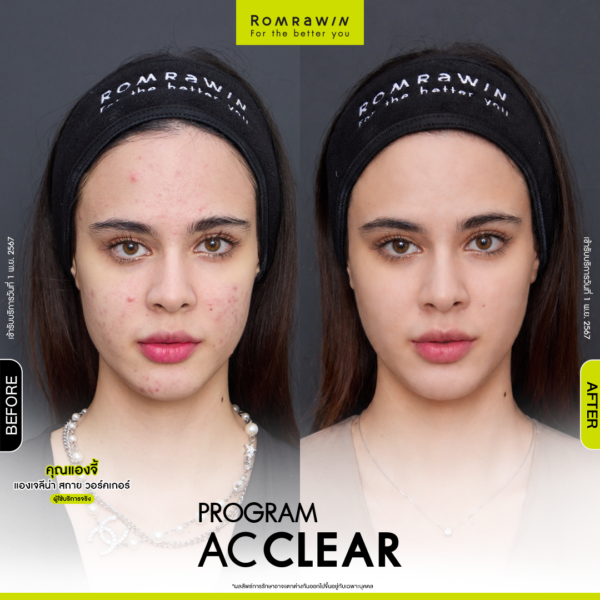 All Review 246 รีวิว Ac Clear คุณแองจี้