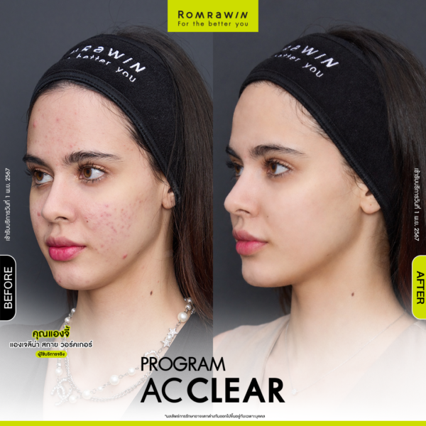 All Review 247 รีวิว Ac Clear คุณแองจี้