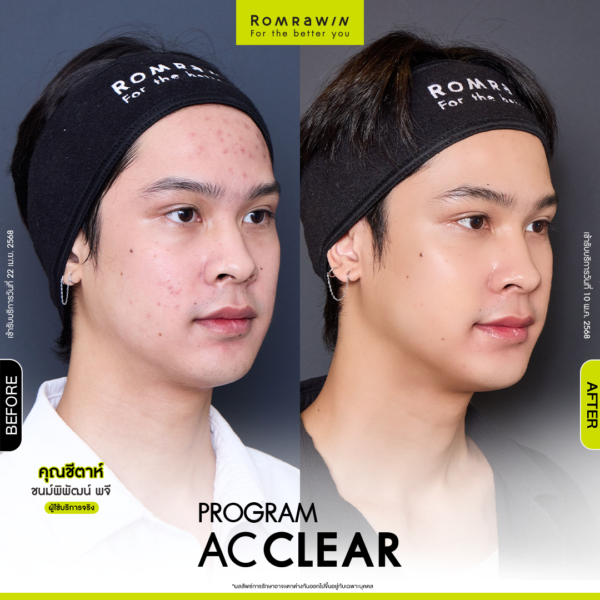All Review 242 รีวิว Ac Clear คุณชีตาห์