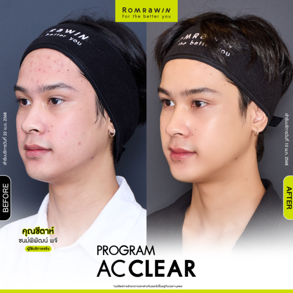 All Review 244 รีวิว Ac Clear คุณชีตาห์
