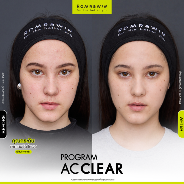 All Review 249 รีวิว Ac Clear คุณกระถิน