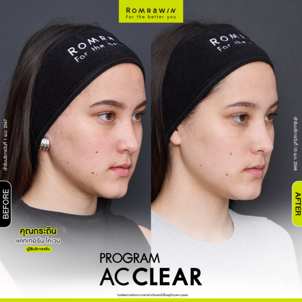 All Review 248 รีวิว Ac Clear คุณกระถิน