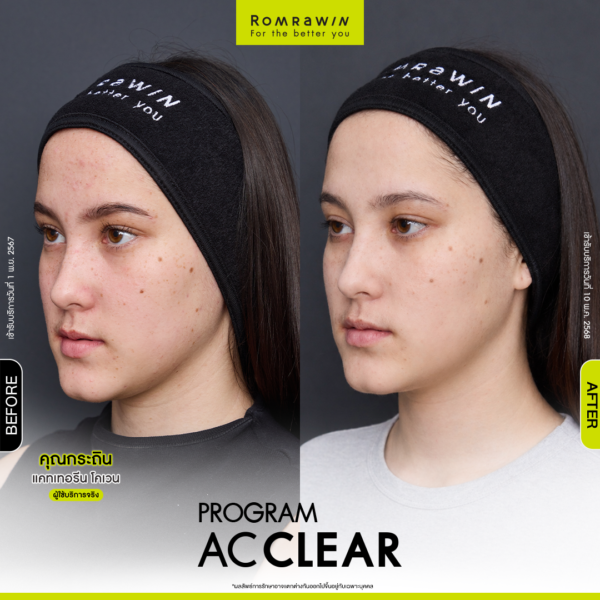 All Review 250 BFAT AcClear kratin 1 1 3