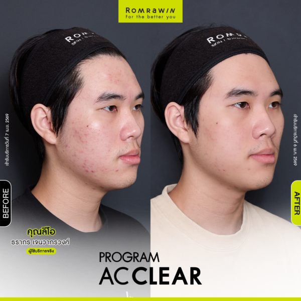 All Review 254 BFAT AcClear leo 1 1 1