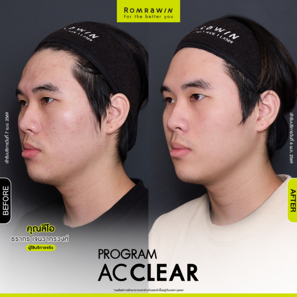 All Review 256 BFAT AcClear leo 1 1 2