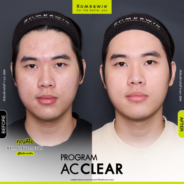 All Review 255 BFAT AcClear leo 1 1 3