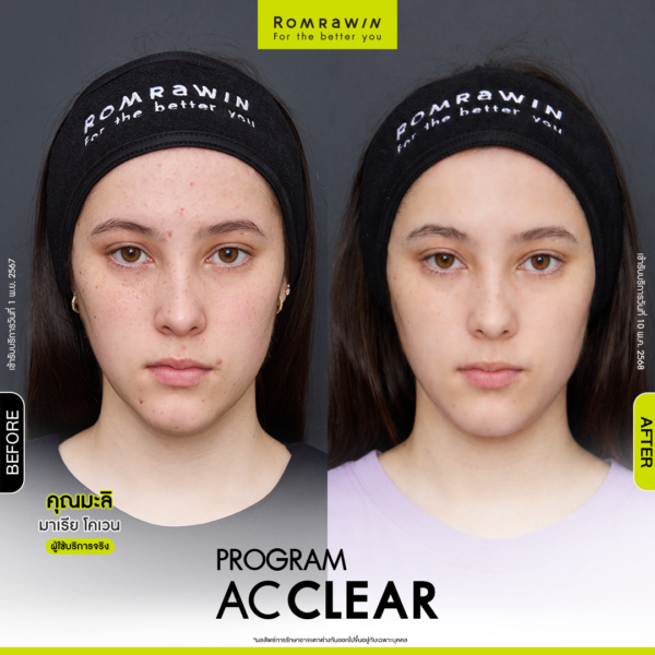 All Review 252 รีวิว Ac Clear คุณมะลิ