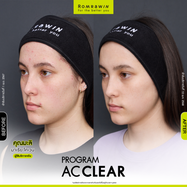 All Review 253 รีวิว Ac Clear คุณมะลิ