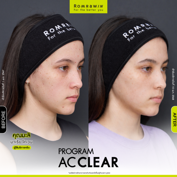All Review 251 รีวิว Ac Clear คุณมะลิ