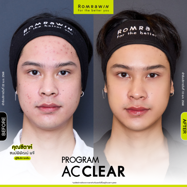All Review 243 รีวิว Ac Clear คุณชีตาห์