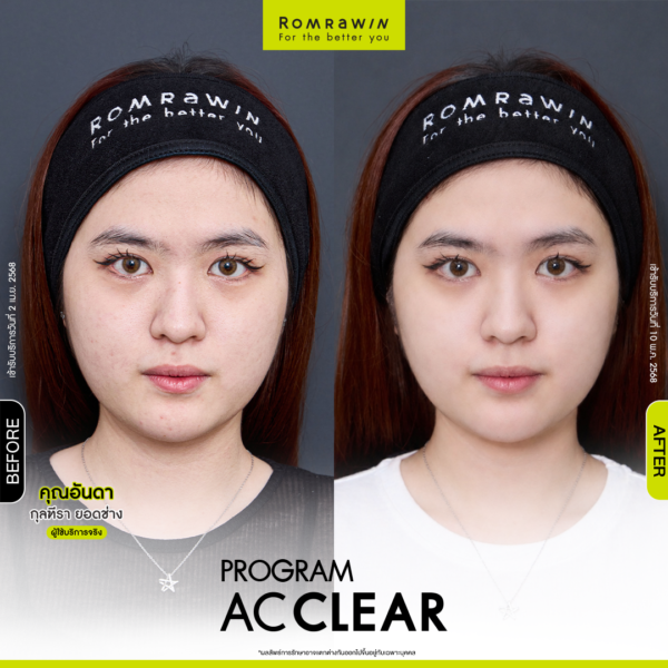 All Review 258 รีวิว Ac Clear คุณอันดา