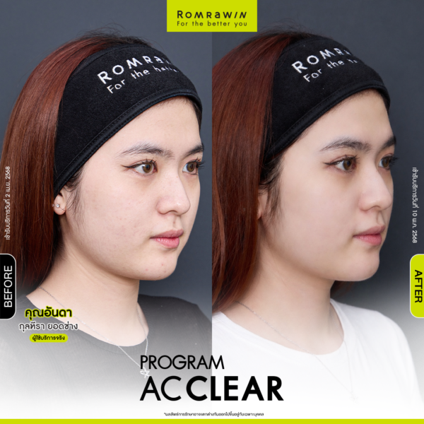 All Review 257 รีวิว Ac Clear คุณอันดา