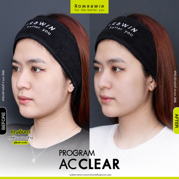 All Review 259 รีวิว Ac Clear คุณอันดา