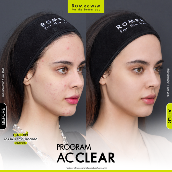 All Review 245 รีวิว Ac Clear คุณแองจี้