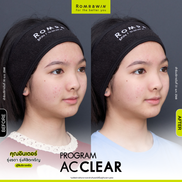 All Review 233 รีวิว Ac Clear คุณอินเตอร์