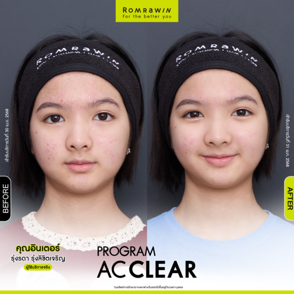 All Review 234 รีวิว Ac Clear คุณอินเตอร์