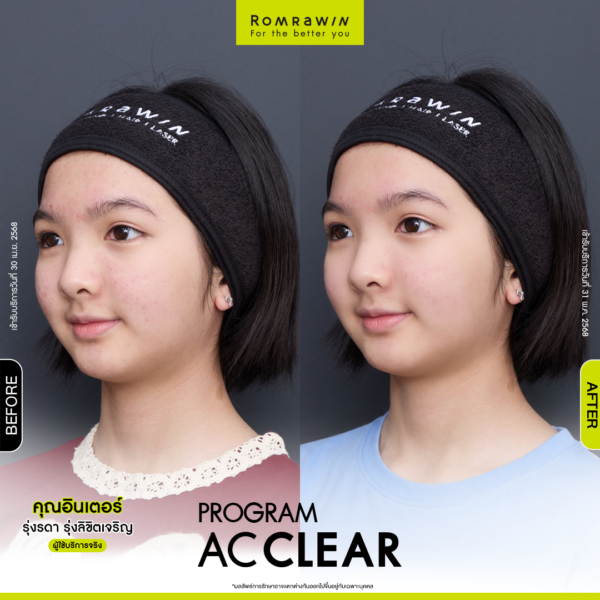 All Review 235 รีวิว Ac Clear คุณอินเตอร์