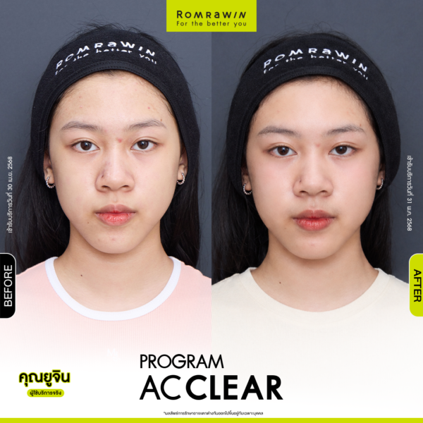 All Review 240 รีวิว Ac Clear คุณยูจิน