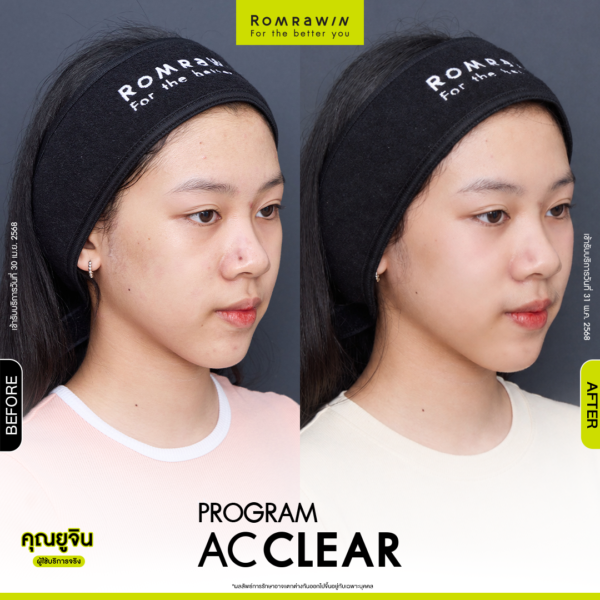 All Review 239 รีวิว Ac Clear คุณยูจิน