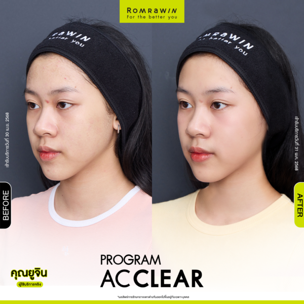All Review 241 รีวิว Ac Clear คุณยูจิน