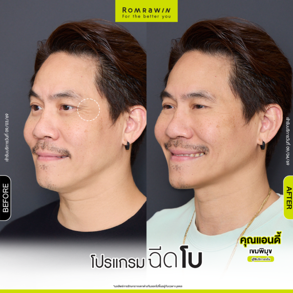 All Review 219 รีวิว โปรแกรมฉีดโบ คุณแอนดี้