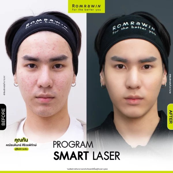 All Review 77 รีวิว Smart Laser คุณกัน