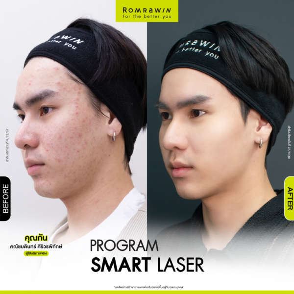 All Review 78 รีวิว Smart Laser คุณกัน
