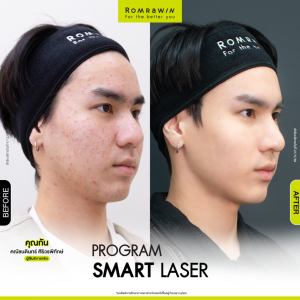 All Review 76 รีวิว Smart Laser คุณกัน
