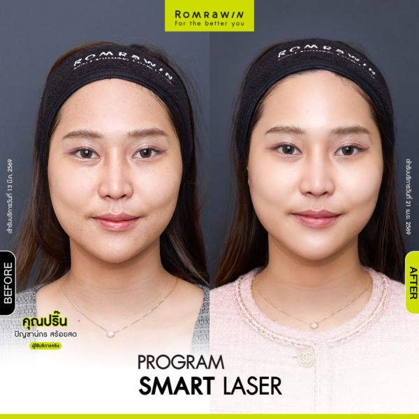 All Review 74 รีวิว Smart Laser คุณปริ๊น