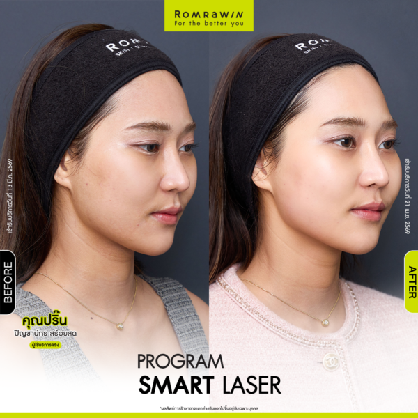 All Review 73 รีวิว Smart Laser คุณปริ๊น