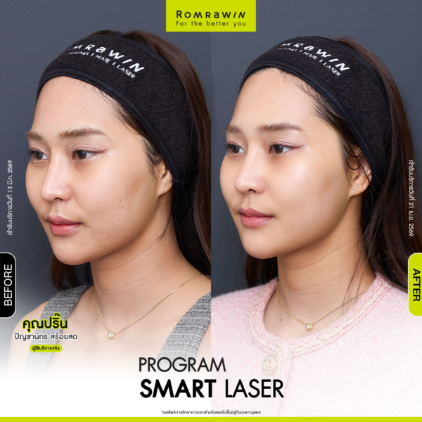 All Review 75 รีวิว Smart Laser คุณปริ๊น