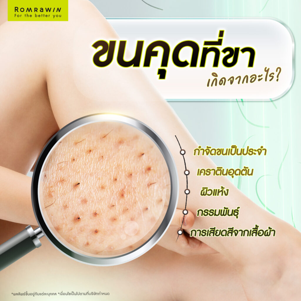 ขนคุดที่ขาเกิดจากอะไร?