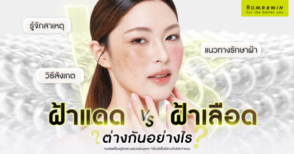 ฝ้าแดดกับฝ้าเลือดต่างกันยังไง
